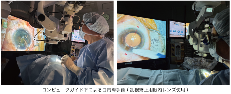 コンピュータガイドによる乱視矯正用眼内レンズの調整