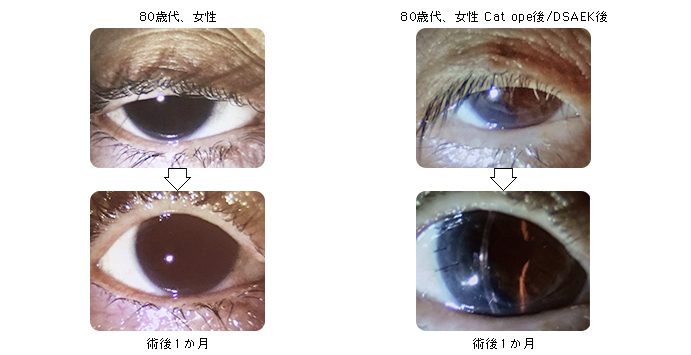 当科における眼瞼下垂手術