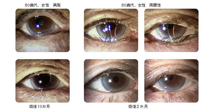 眼瞼内反に対する眼輪筋下方固定術